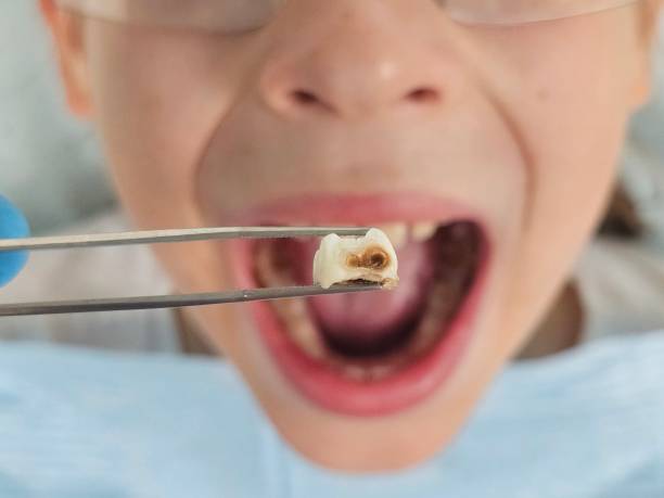 Best Broken or Cracked Tooth Emergency Dentist in Oroville, WA